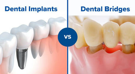 How do older people choose the right one for them, dental implants or dentures?